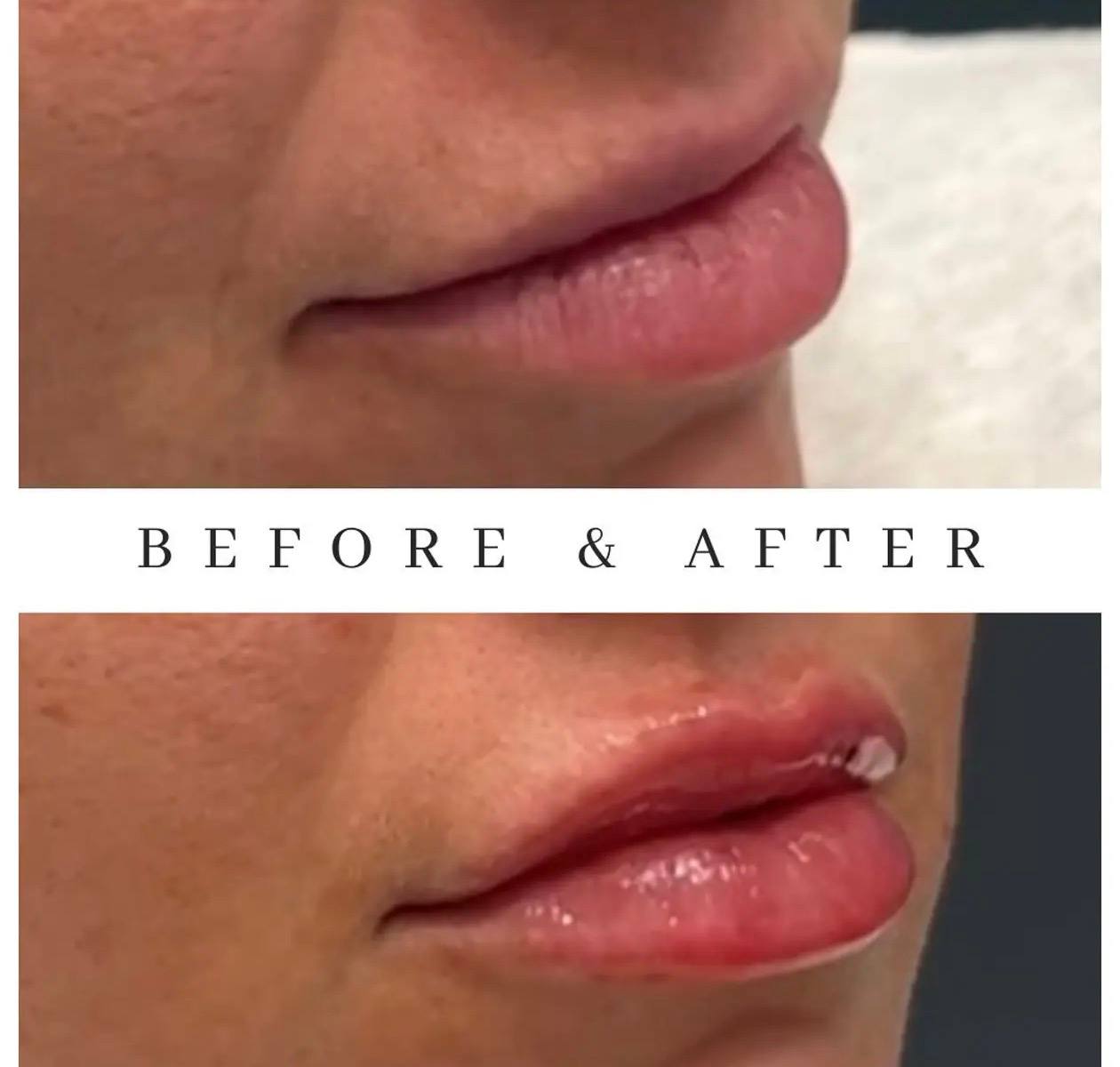 Before and after lip filler treatment at Elements Med Lounge — natural lip volume restoration in profile view
