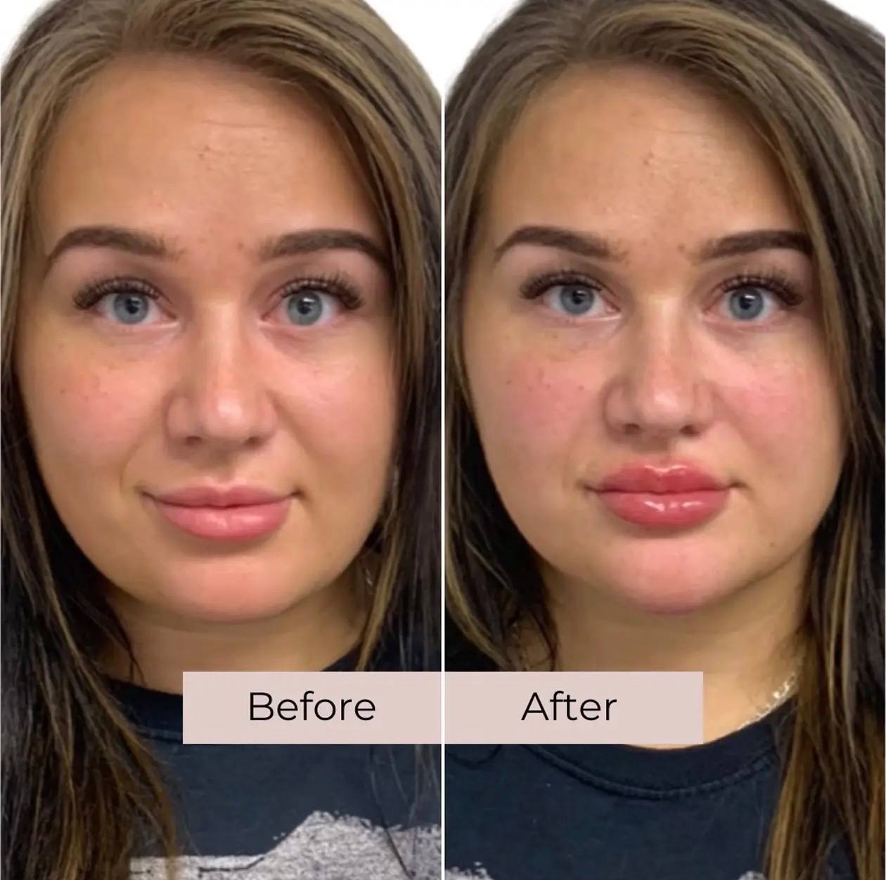 Before and after lip filler treatment at Elements Med Lounge — front-facing lip enhancement preserving natural proportions