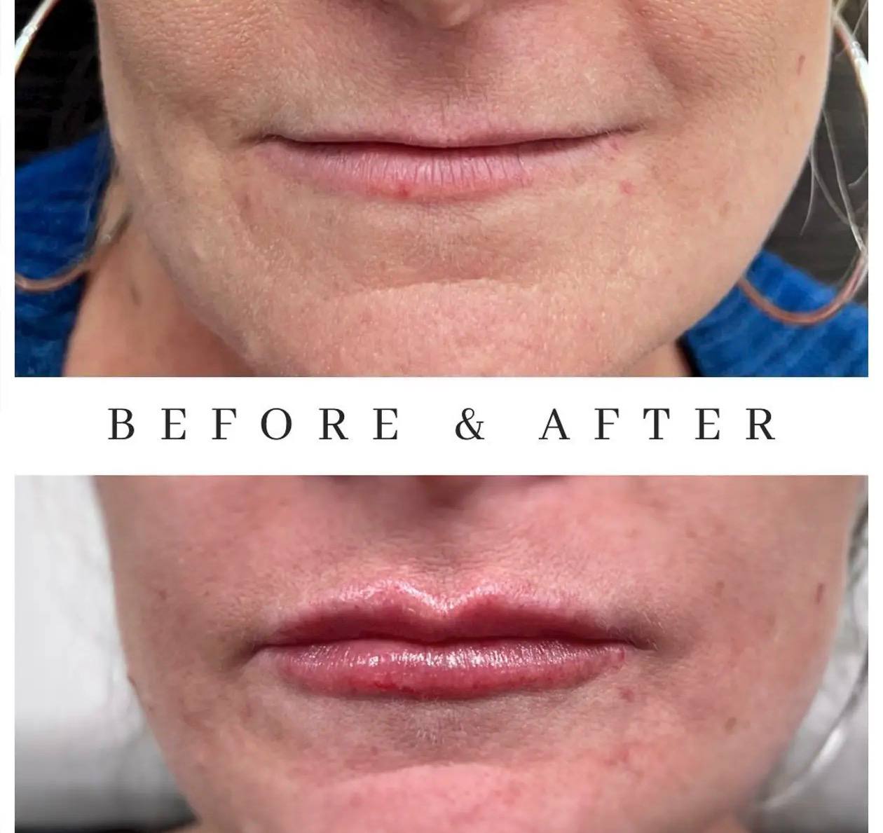 Before and after lip filler treatment at Elements Med Lounge — full lip enhancement and contour