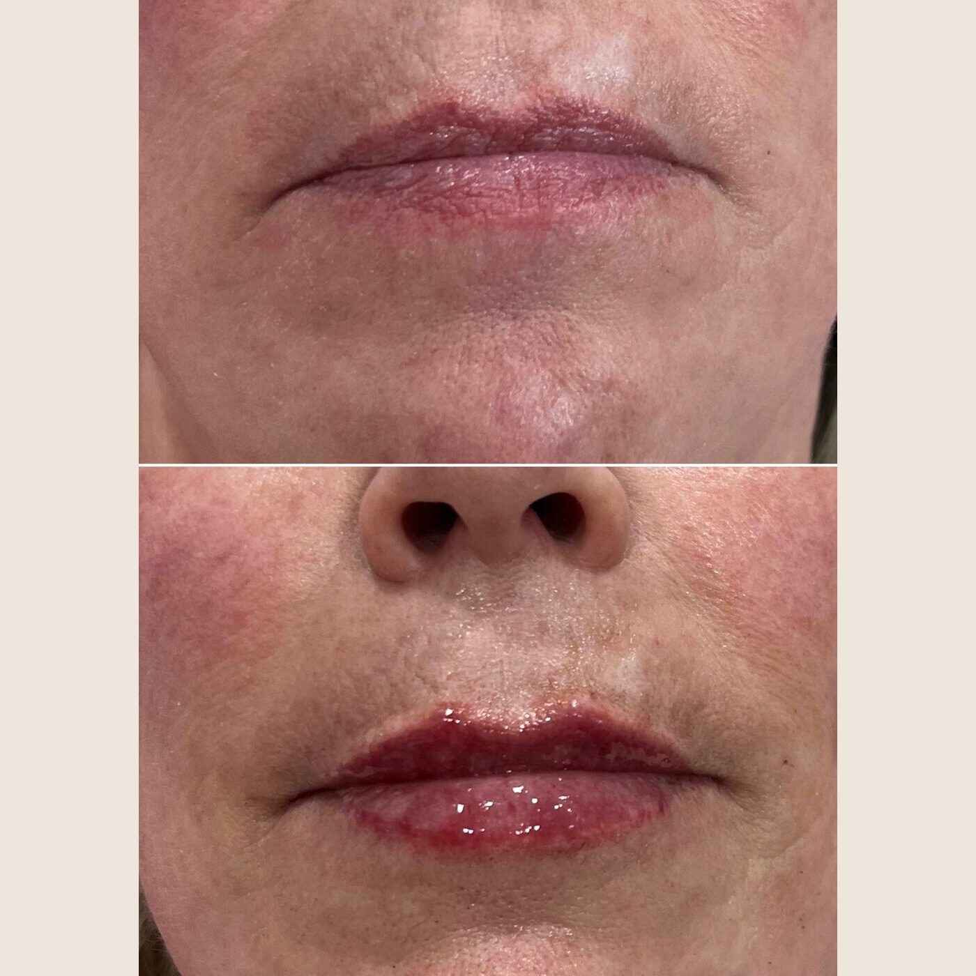 Before and after lip filler treatment at Elements Med Lounge — subtle volume with a natural lip shape