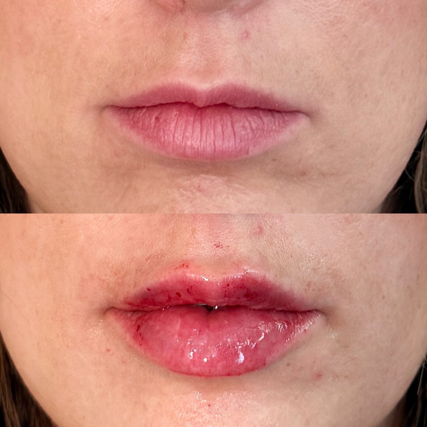 Before and after lip filler treatment at Elements Med Lounge — added definition and hydration to the lips