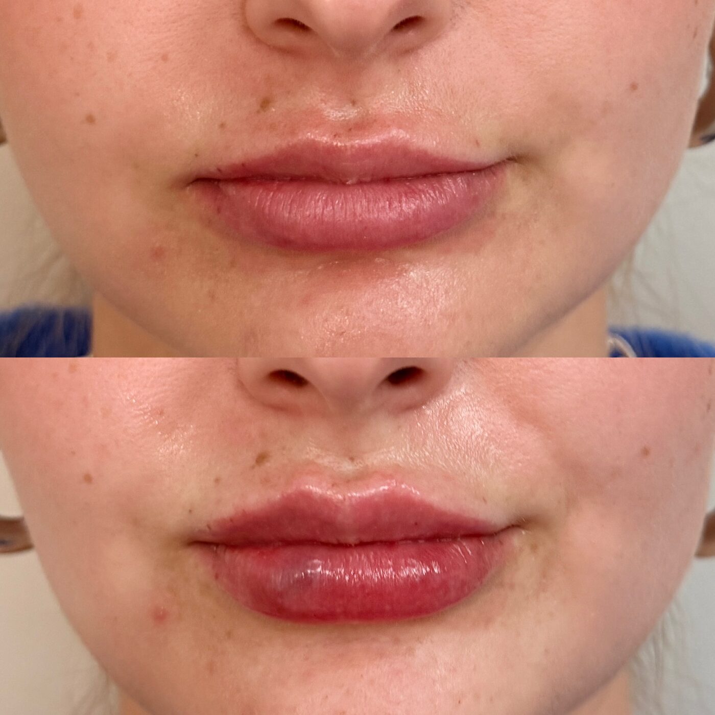 Before and after lip filler treatment at Elements Med Lounge — soft, natural lip enhancement