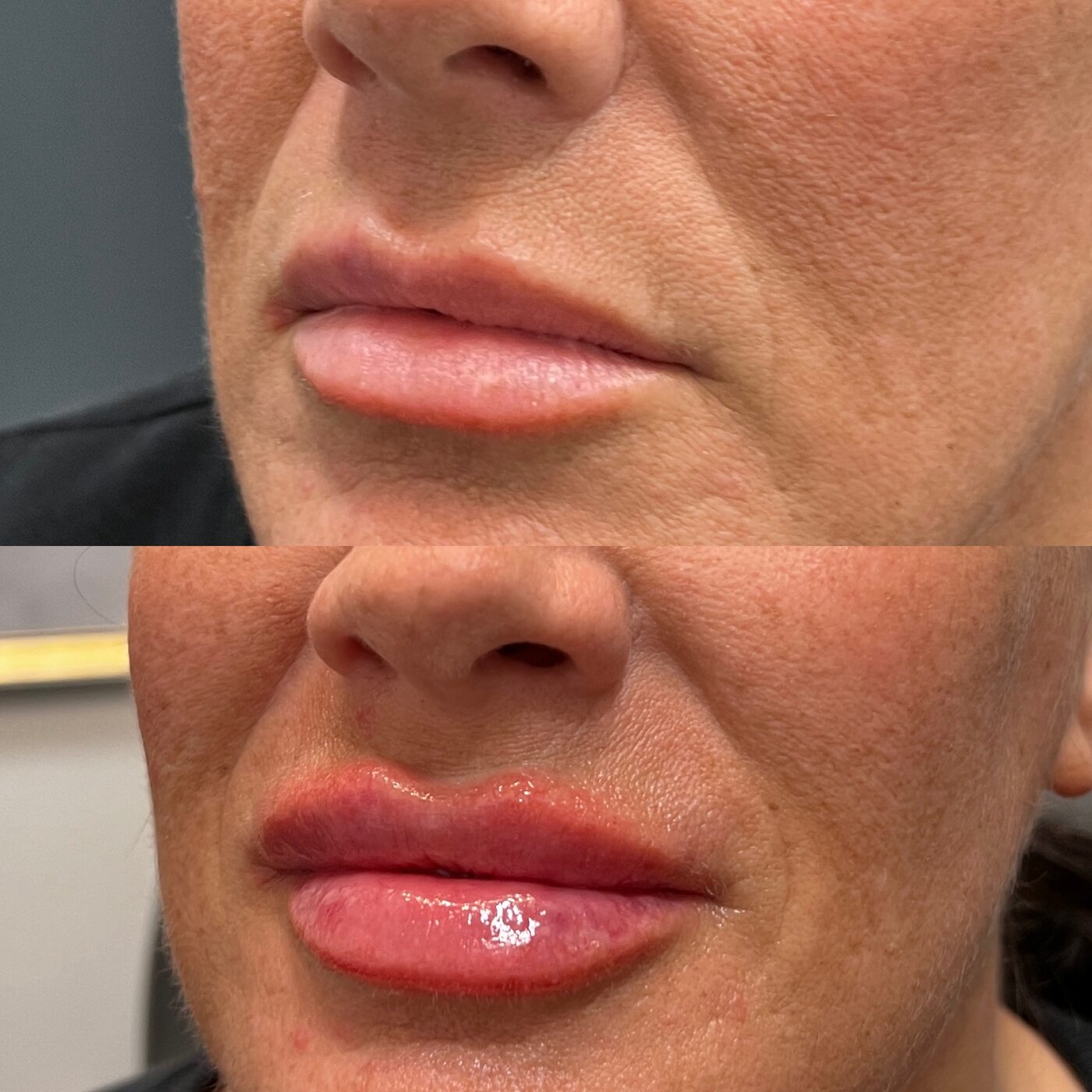 Before and after lip filler treatment at Elements Med Lounge — balanced, fuller lips